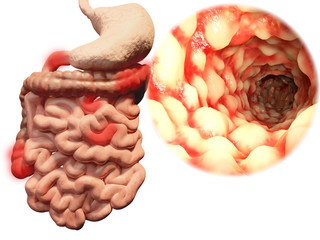 Morbus Crohn im Gastrointestinaltrakt