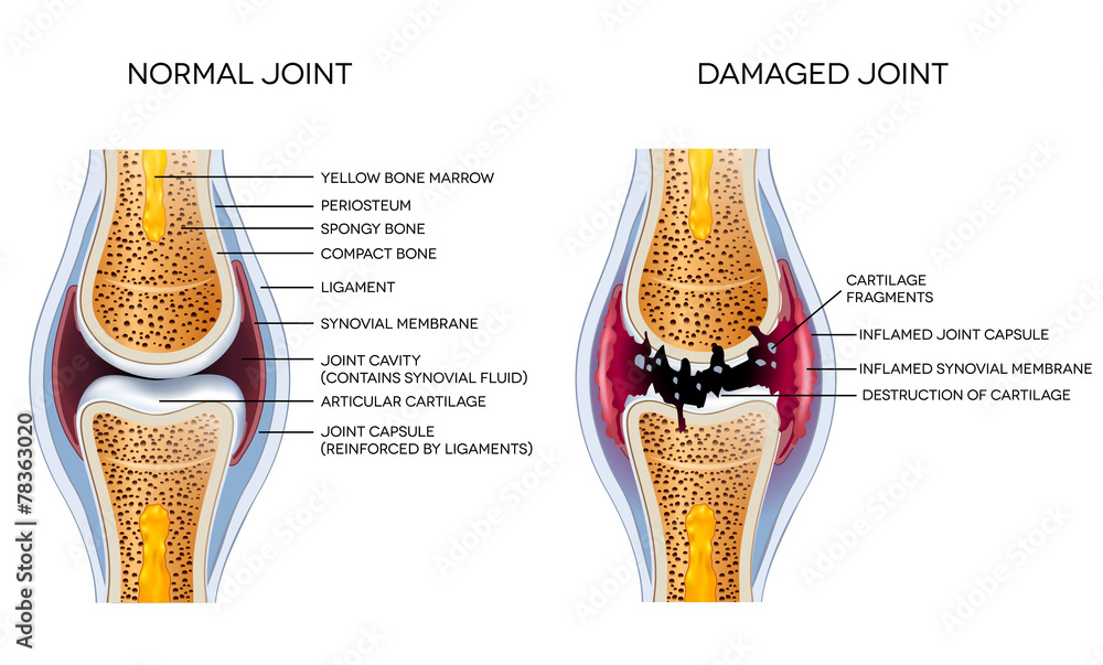 Wall mural damaged joint and healthy joint detailed diagram