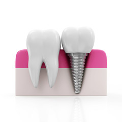 Health Tooth and Dental implant isolated on white background