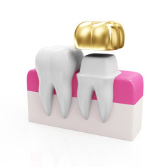 Health Tooth and Teeth with Golden Dental Crown