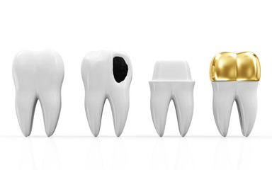 Helath Tooth, Teeth with Caries and Golden Dental Crown
