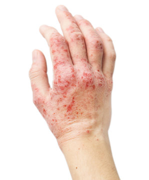 Eczema On A Female Hand