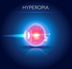 Hyperopia eyesight disorder