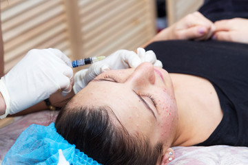 Obraz na płótnie Canvas Injections on the face with cosmetic procedures.