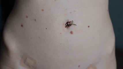 Tripe, scar after surgery. Close up.