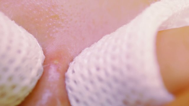 Close up of squeezing the infected pustulous acne to inoculation