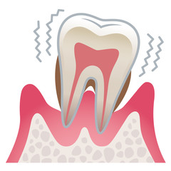 歯の断面図　歯周病