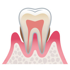 歯の断面図　歯周病