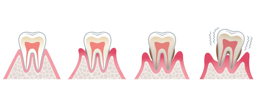 歯の断面図　歯周病