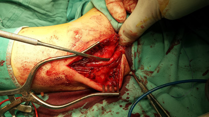 ulnar nerve surgery