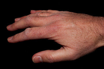 Hand with Dry Skin