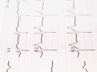 Electrocardiogram, ECG printout, EKG background