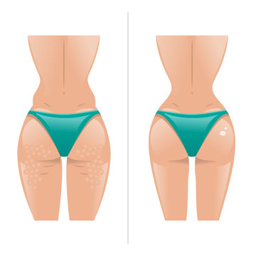 Vector illustration of cellulite and healthy skin