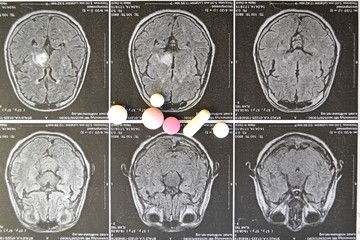 снимок инсульт  кровоизлияние в мозг