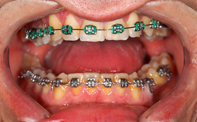 Obraz premium Dental braces