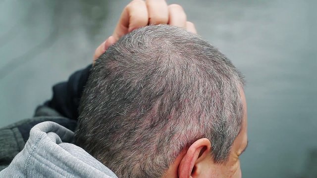 Man with itchy head at outdoors