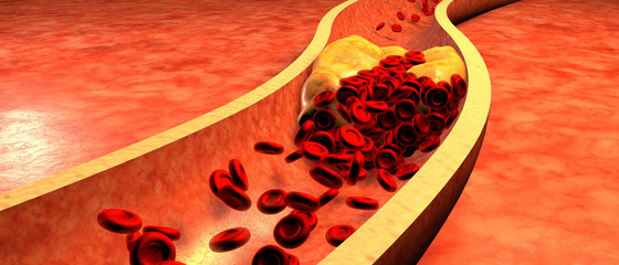 Clogged Artery with platelets and cholesterol plaque