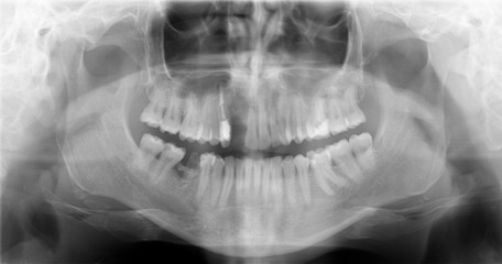 Dental X-ray