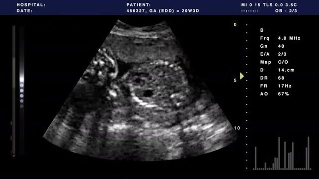 Video out put from an ultrasound combined with graphics.