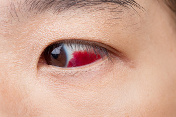 Obraz premium Eye injury or infected for healthy concept, macro closeup