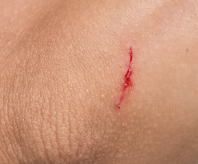 Fototapeta premium wound