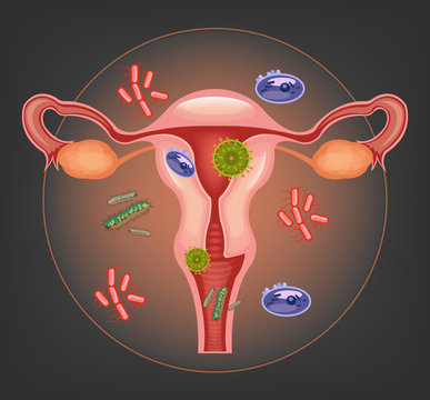Ill female reproductive system. Vector illustration