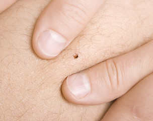 removing a tick from skin