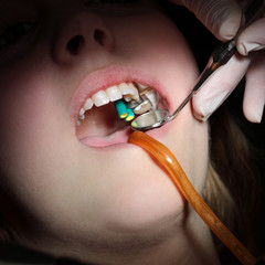 Dental procedure, drilling and filling tooth