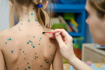 Lubrication zelenkoj chickenpox sores on back of a little girl