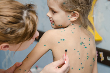 Little girl with chickenpox sores smeared zelenkoj