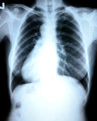 Chest x-ray