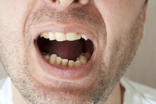 Diseased teeth of the patient.