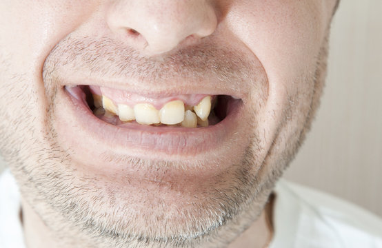 Diseased teeth of the patient.