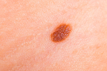 Birthmark