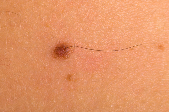 Birthmark