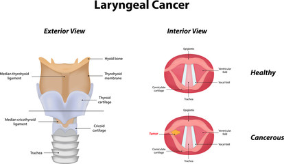 Laryngeal Cancer