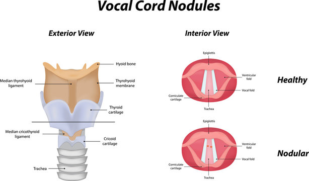 Vocal Cord Nodules