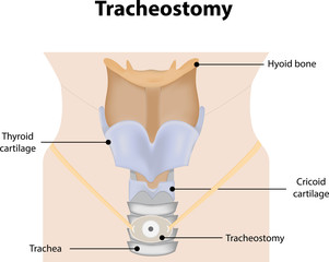Tracheostomy Labeled Diagram