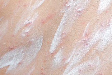 Fototapeta premium Detail baby with chicken pox rash