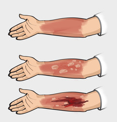 Classification of burns. Thermal injuries.