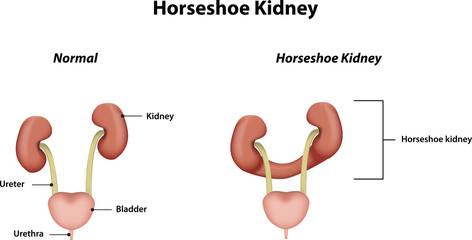 Horseshoe Kidney
