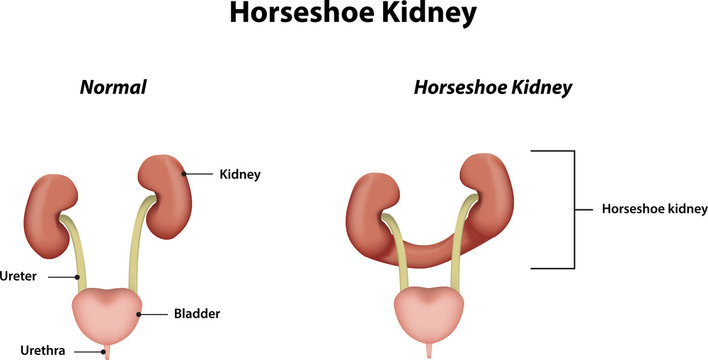 Horseshoe Kidney Labeled Diagram