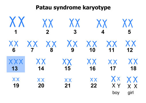 Patau syndrome