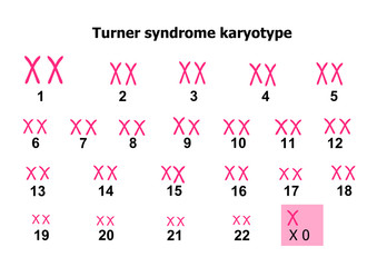 Turner syndrome karyotype