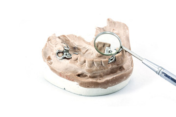 Dental cast with metal framework for partial denture