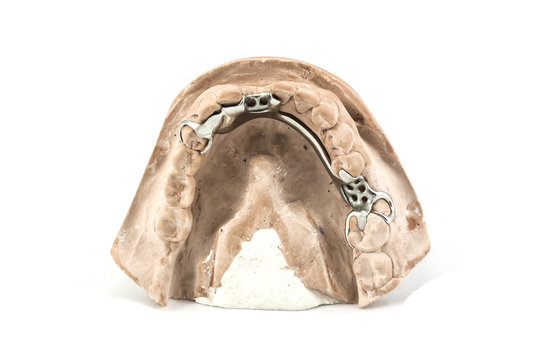 Dental cast with metal framework for partial denture