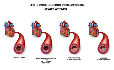 Heart attack, Coronary artery disease. Heart muscle damage