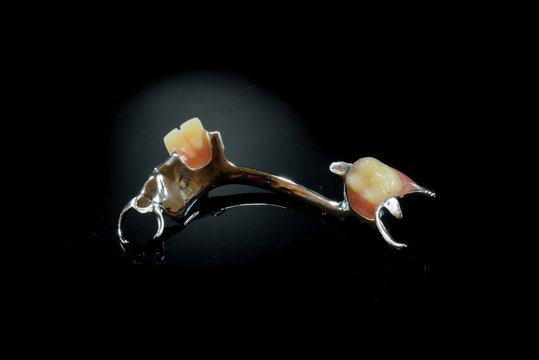 Metal base partial denture