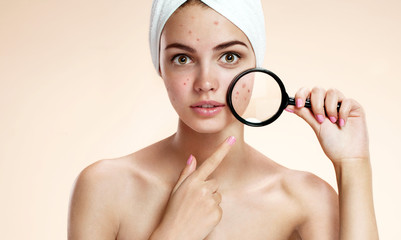 girl with problem skin look at pimple with magnifying glas