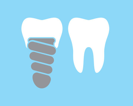 Dental implant vector icon